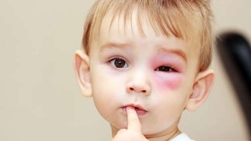 Các biểu hiện và triệu chứng cụ thể khi trẻ bị côn trùng đốt sưng mắt là gì?
