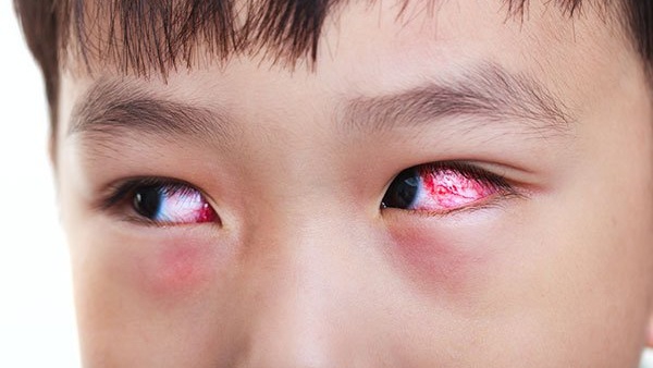 Chế độ ăn uống và sinh hoạt nào có thể hỗ trợ điều trị đau mắt đỏ ở trẻ em?
