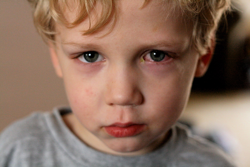 Chất gây dị ứng có thể gây thâm quầng mắt ở trẻ 2 tuổi không?

