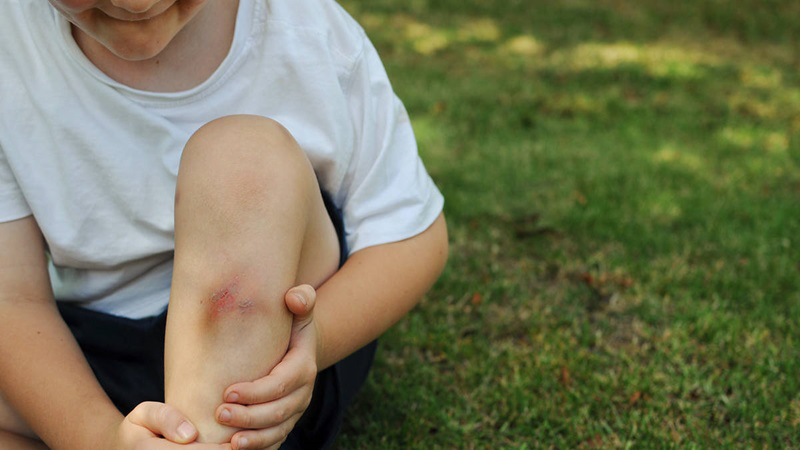 Bé hay bị vết bầm tím ở chân: Nguyên nhân và cách xử trí phù hợp 2