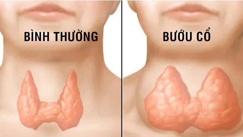 Bệnh Bướu Cổ Có Nguy Hiểm Không?