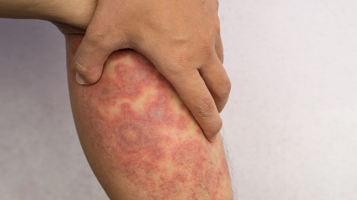 Các triệu chứng của bệnh chàm khô tróc vảy là gì?
