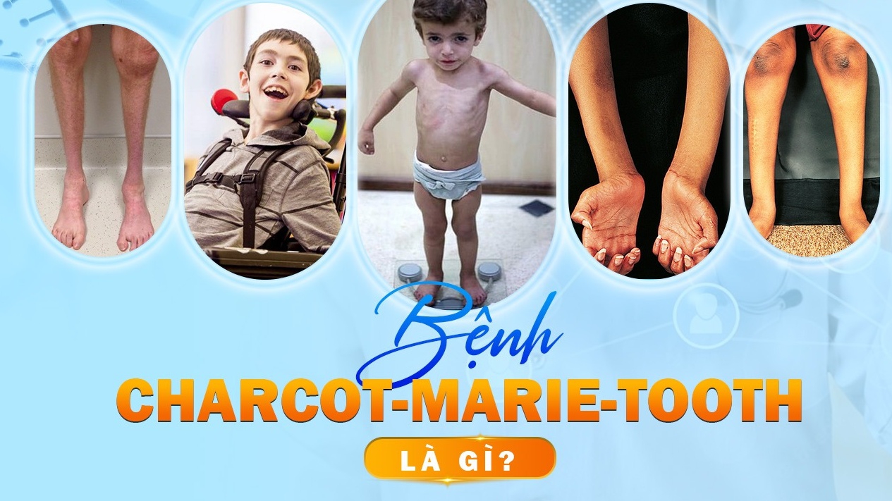 Bệnh Charcot-Marie-Tooth là bệnh gì?