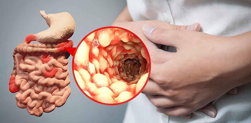 Hỏi đáp: Bệnh Crohn có chữa khỏi không?  1