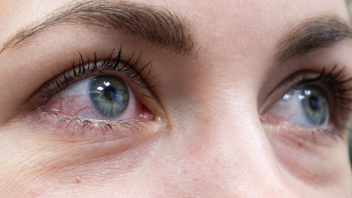 Nguyên nhân nào làm cho mắt đỏ và đau rát?
