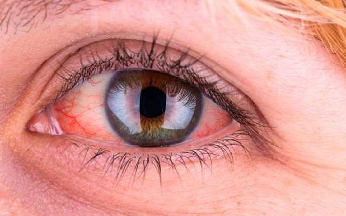 Bệnh Lậu Ở Mắt: Tất Cả Bạn Cần Biết về Nguyên Nhân, Triệu Chứng và Điều Trị
