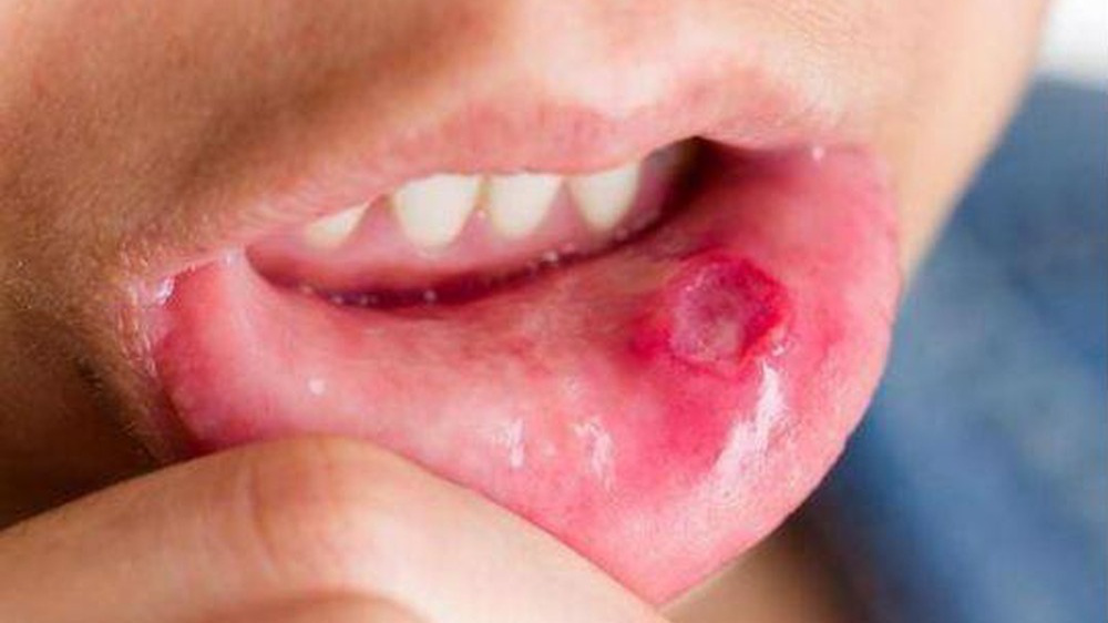 Các biện pháp phòng ngừa lở miệng thiếu chất gì?
