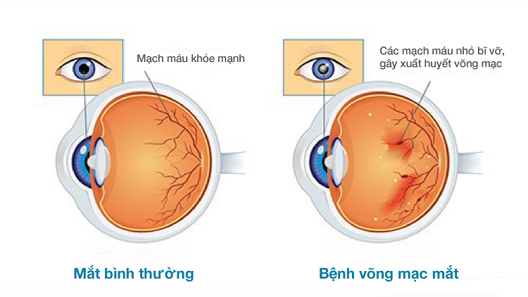 Bệnh bong võng mạc đái tháo đường và những điều cần biết