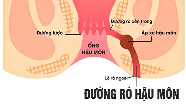 Bệnh lý rò hậu môn có nguy hiểm không?