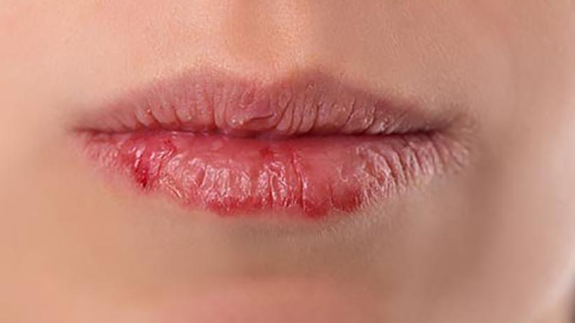 Triệu chứng của bệnh chàm môi là gì?
