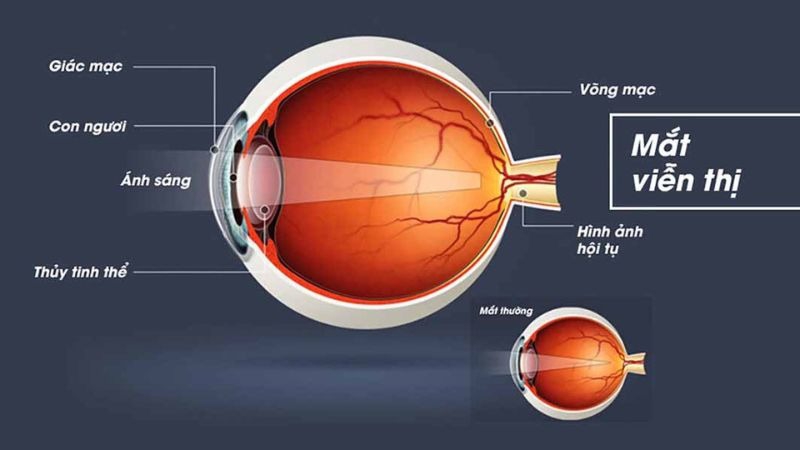 Bệnh nhân mắt bị viễn thị bẩm sinh có mổ được không? 1