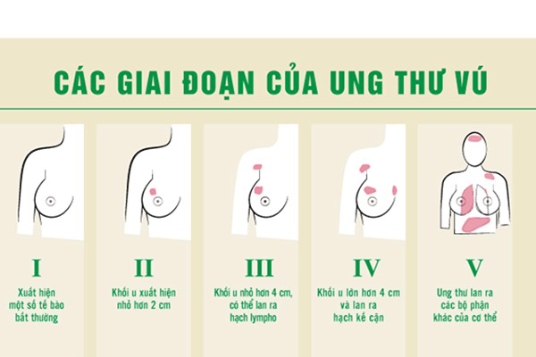 Bệnh nhân ung thư vú sống được bao lâu? 1