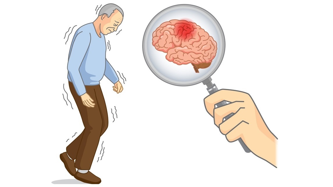 Tại sao bệnh Parkinson được coi là một rối loạn thoái hóa chậm tiến triển? 
