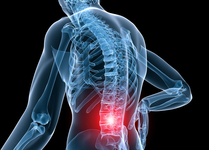 Bệnh rễ thần kinh thắt lưng: Nguyên nhân, triệu chứng và cách khắc phục 1