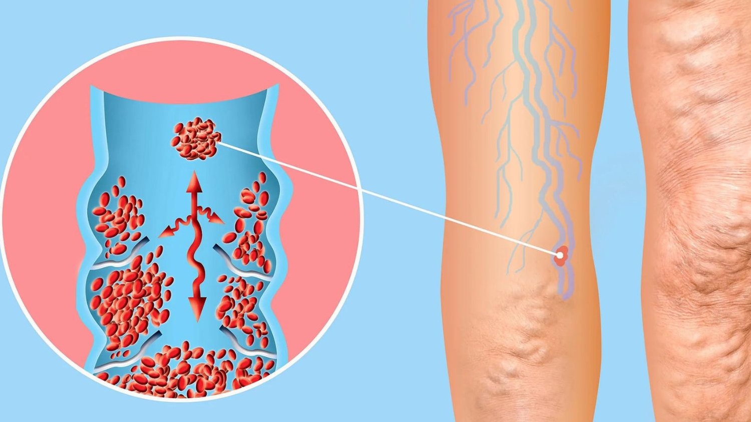 Bệnh suy giãn tĩnh mạch: Nguyên nhân, triệu chứng và cách điều trị