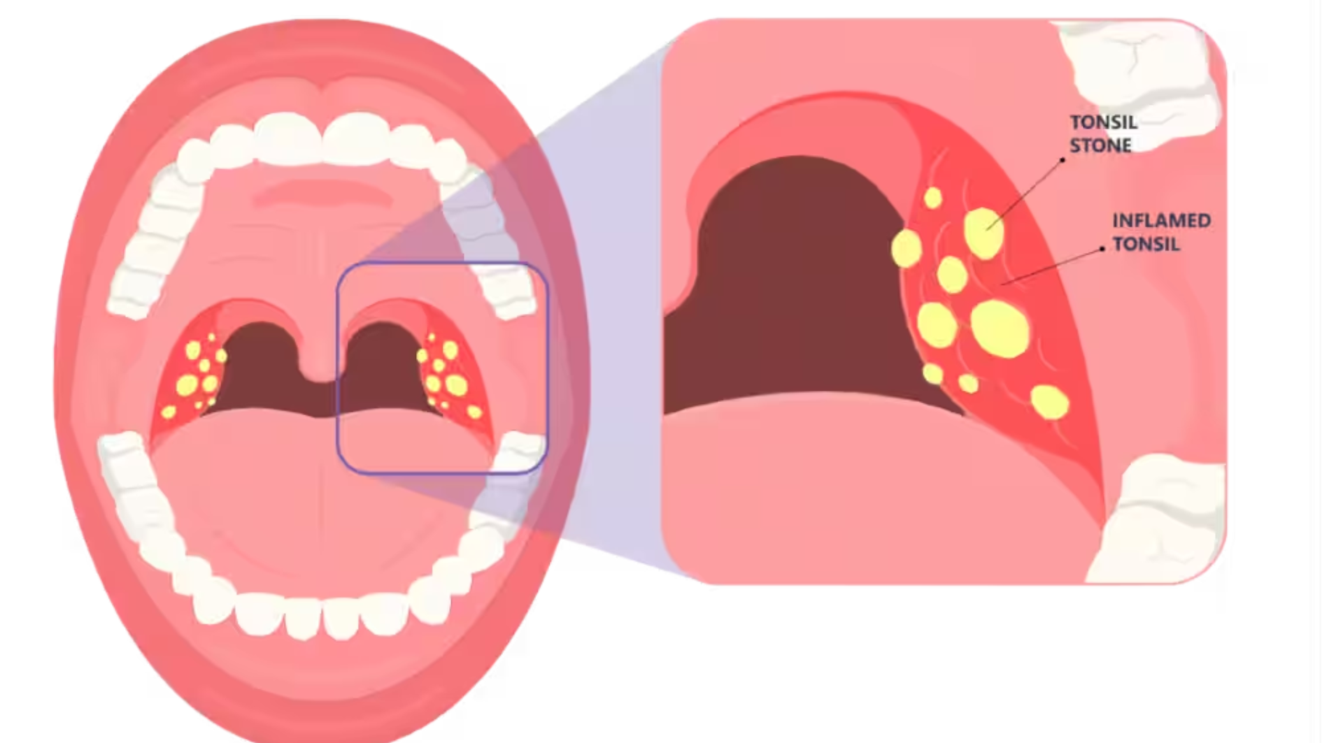 Tonsil stone là gì? Cách điều trị và phòng ngừa tonsil stone