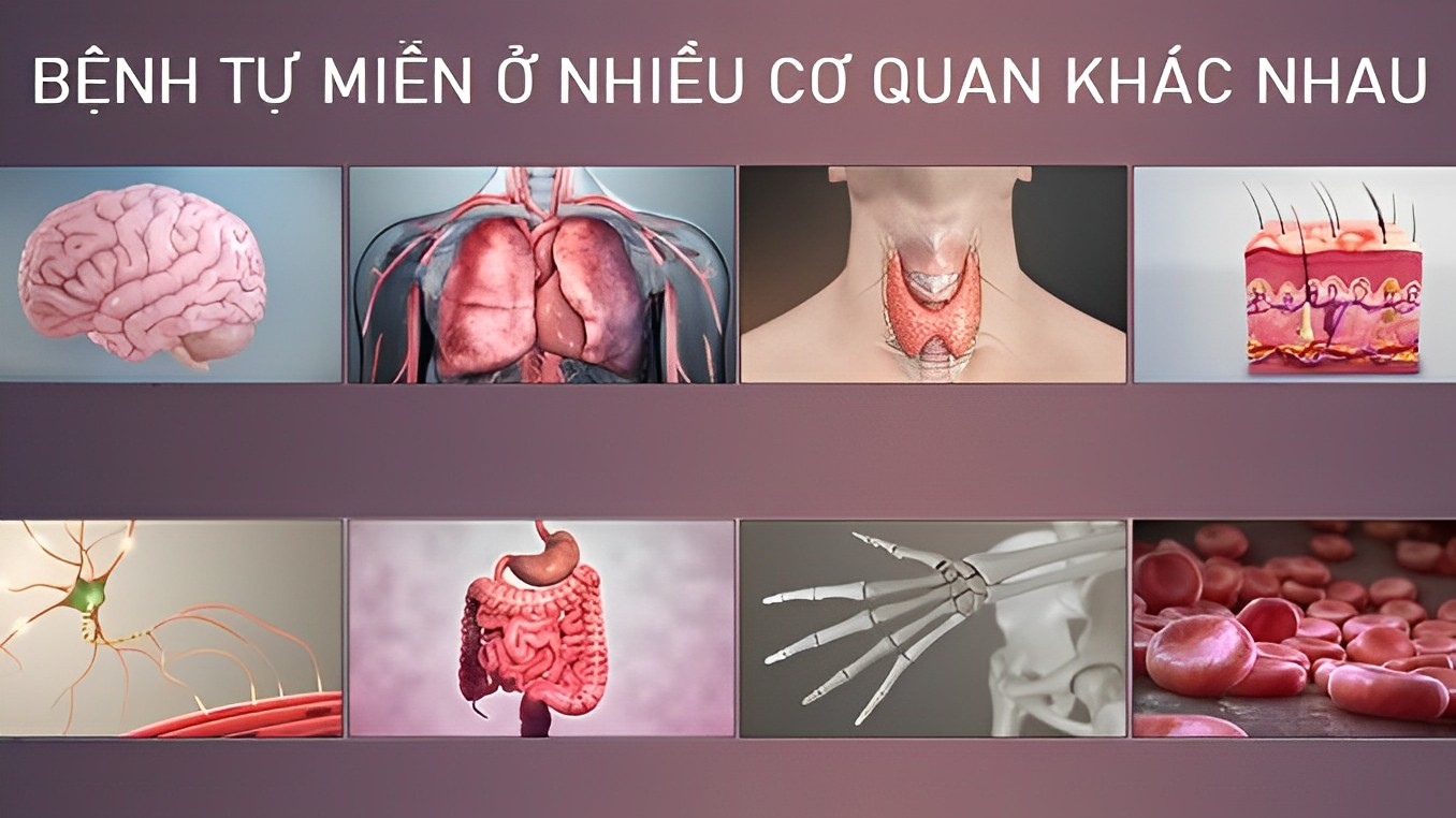 Bệnh tự miễn có nguy hiểm không?