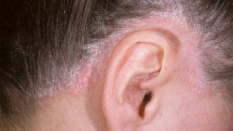 Bệnh vảy nến da đầu: Nguyên nhân, dấu hiệu và cách điều trị 2