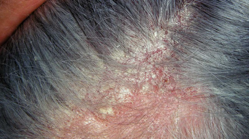 Bệnh vảy nến da đầu: Nguyên nhân, dấu hiệu và cách điều trị 6