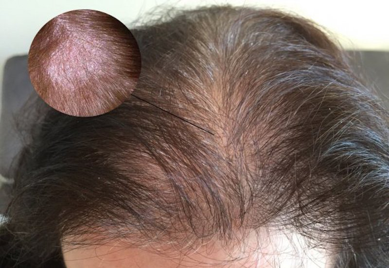 Bệnh vảy nến da đầu: Nguyên nhân, dấu hiệu và cách điều trị 3