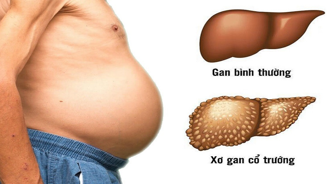 Bệnh xơ gan cổ trướng có lây không?