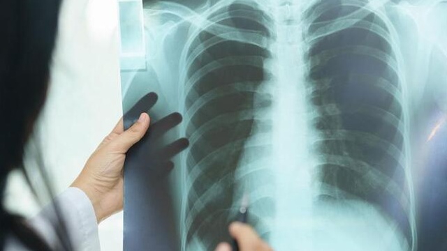  Bị xơ phổi sống được bao lâu : Tìm hiểu về giải pháp điều trị hiệu quả