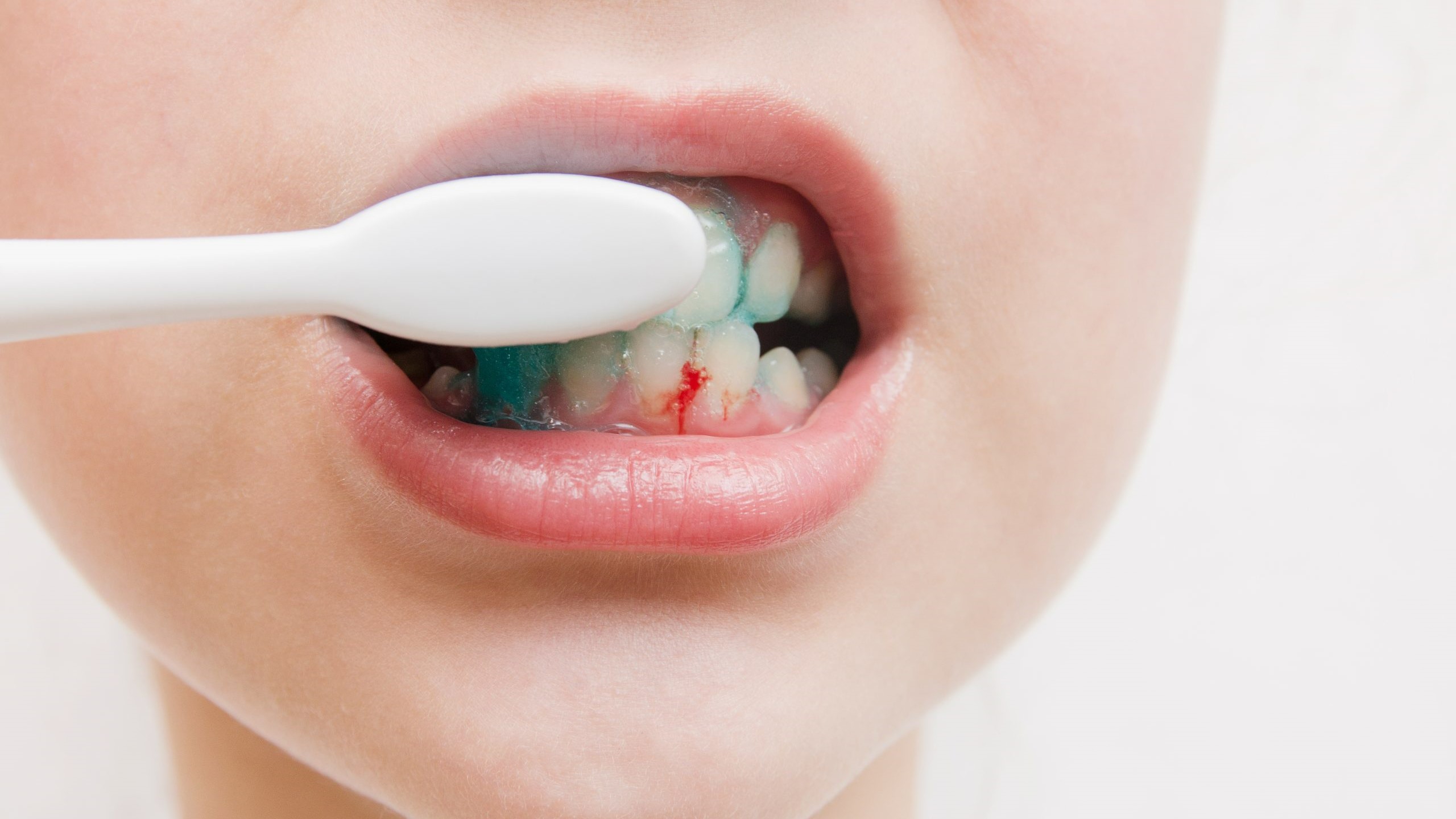 Ngoài thuốc trị chảy máu chân răng, còn có cách trị khác không?

