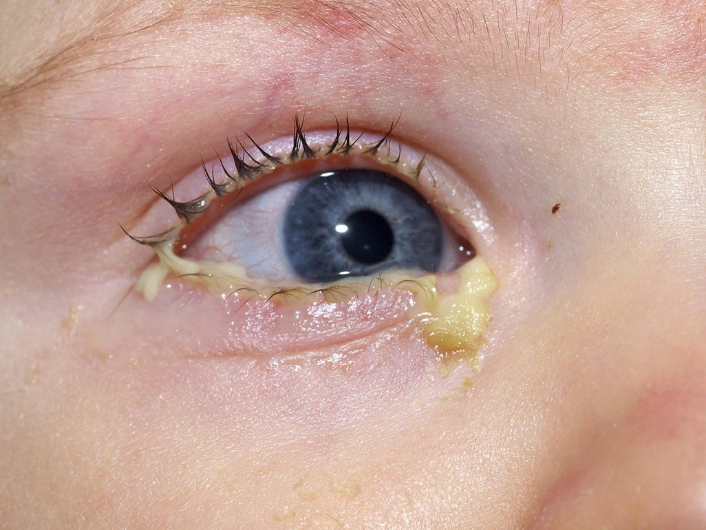 Bệnh đau mắt đỏ có ảnh hưởng gì đến sức khỏe không?
