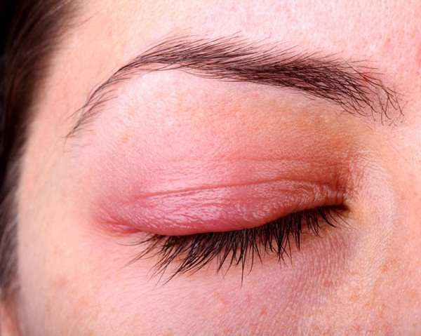 Các triệu chứng khác đi kèm với mắt đỏ và sưng húp là gì?
