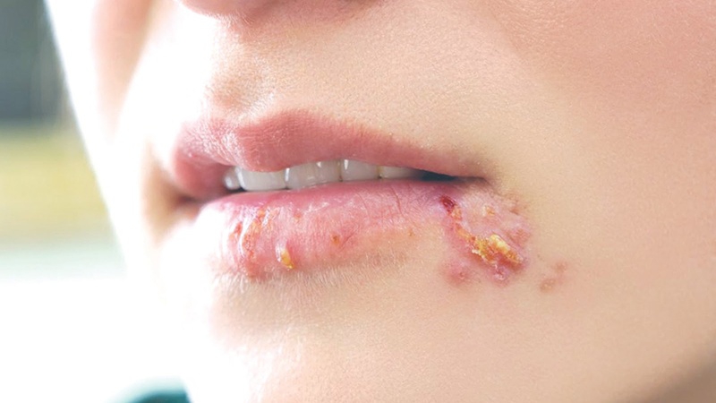 Virus herpes ở môi kiêng ăn gì để giảm triệu chứng và ngăn ngừa lây lan?