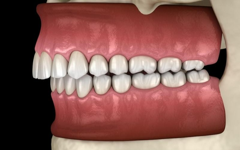 Bị hô hàm có niềng răng được không? Có những phương pháp niềng răng nào?2