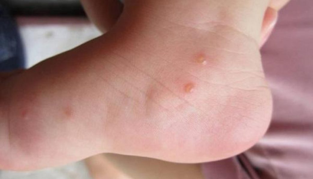 What are the symptoms of getting bitten by a fire ant?