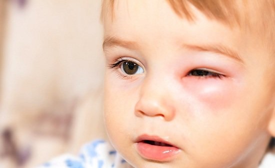 Có những triệu chứng nào khác đi kèm khi bị kiến cắn sưng mắt?
