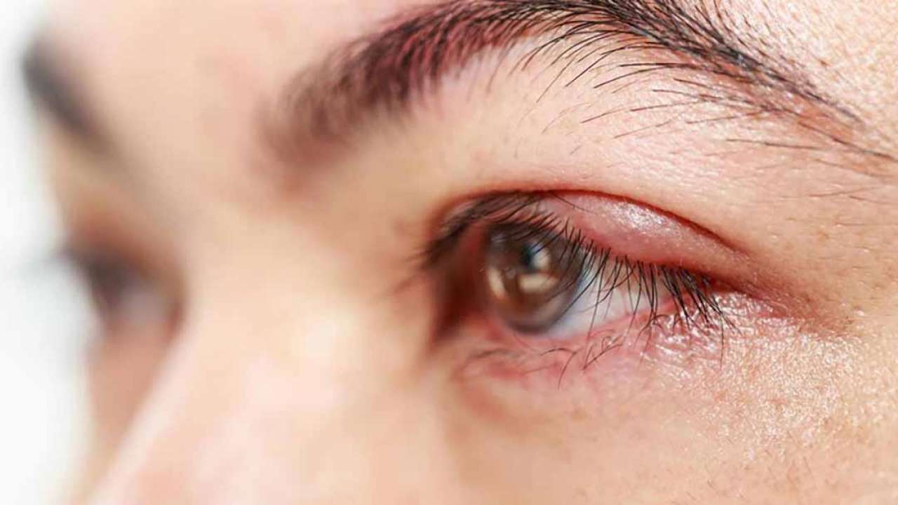 Tác dụng của việc kiêng chạm tay và chà xát mắt khi bị lẹo mắt là gì?
