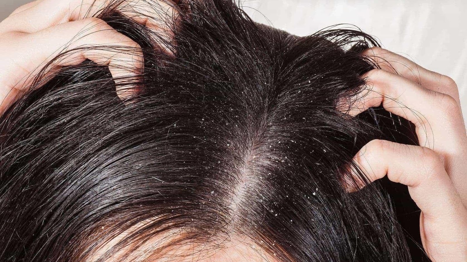 Nấm da đầu có liên quan đến chế độ ẩm ướt không? 
