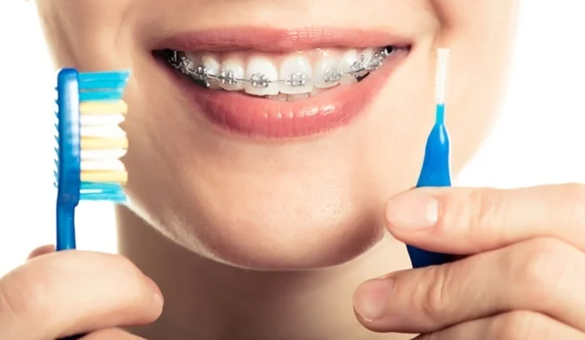 Bị nhiệt miệng khi niềng răng phải làm sao? Cách xử lý hiệu quả 3