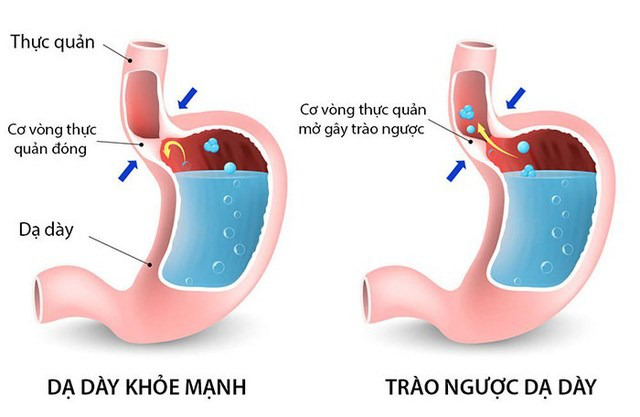 Bị trào ngược dạ dày nằm nghiêng bên nào? 1