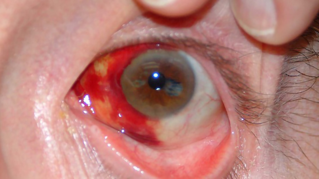 Viêm kết mạc có thể làm chảy máu mắt không?
