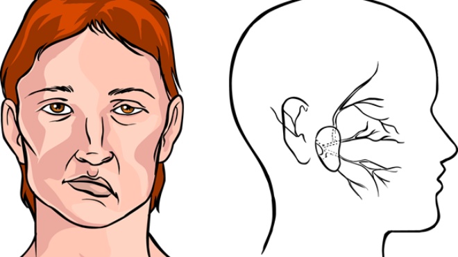 Biến chứng nguy hiểm khi điều trị phẫu thuật liệt dây thần kinh số 7