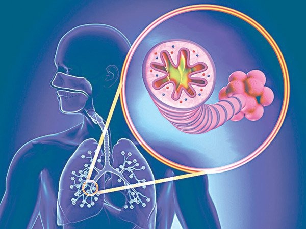 Biến chứng tăng áp động mạch phổi nguy hiểm như thế nào?