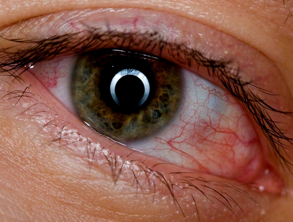 Liệu đau mắt đỏ có phải là triệu chứng của sốt? 
