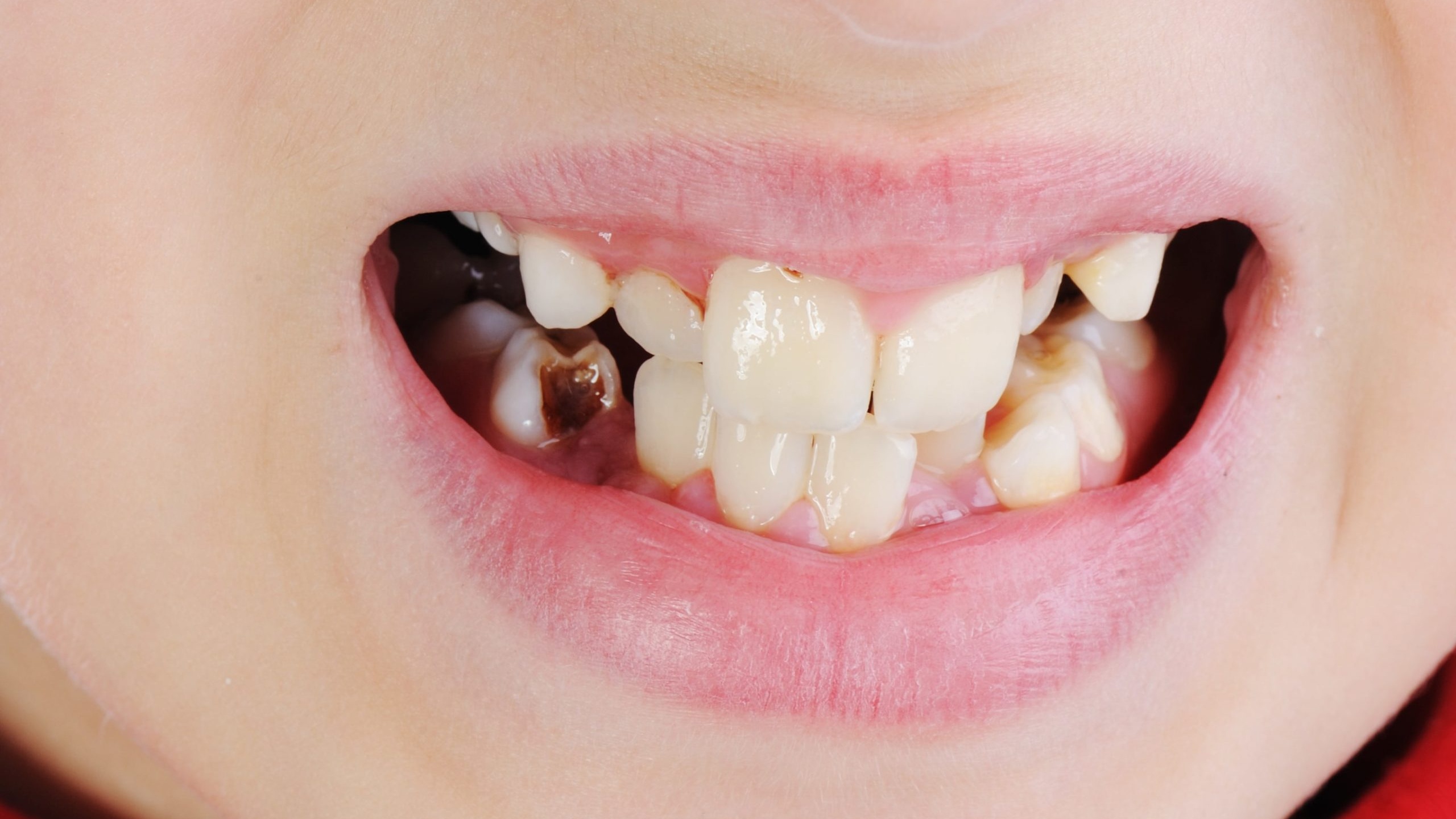 Làm thế nào để chẩn đoán và xác định răng sâu độ 4?
