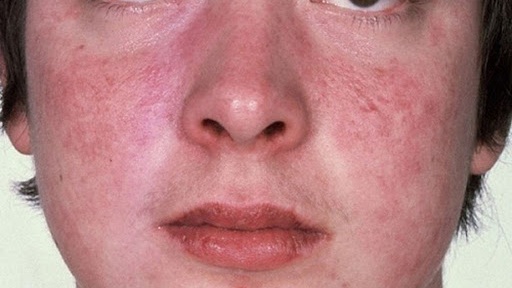 Bệnh lupus ban đỏ ở nam giới là gì?
