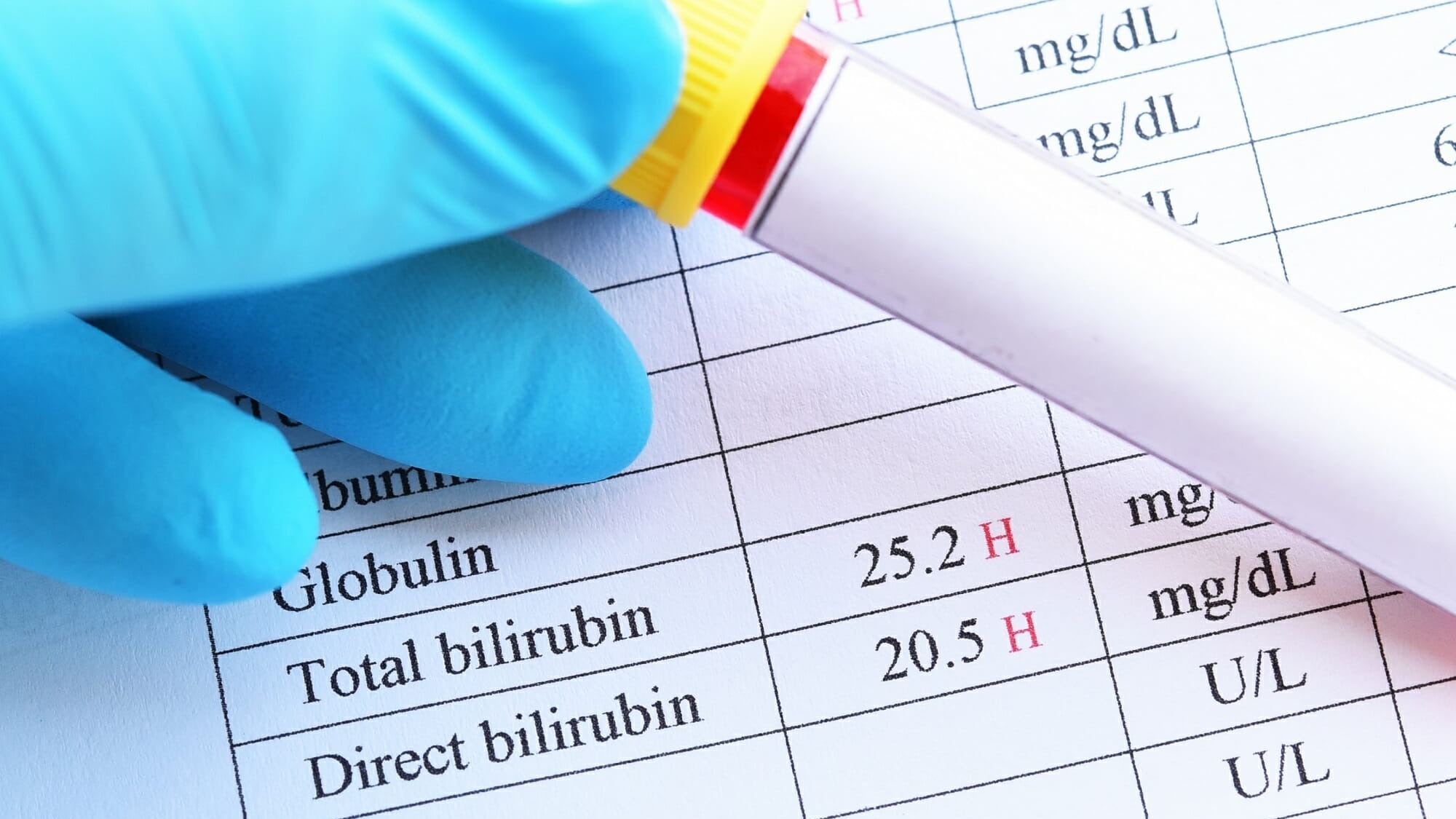 Bilirubin trực tiếp có ý nghĩa gì trong chẩn đoán vàng da?