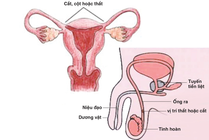 birth-control-la-gi-nhung-phuong-phap-duoc-su-dung-pho-bien 3.jpg
