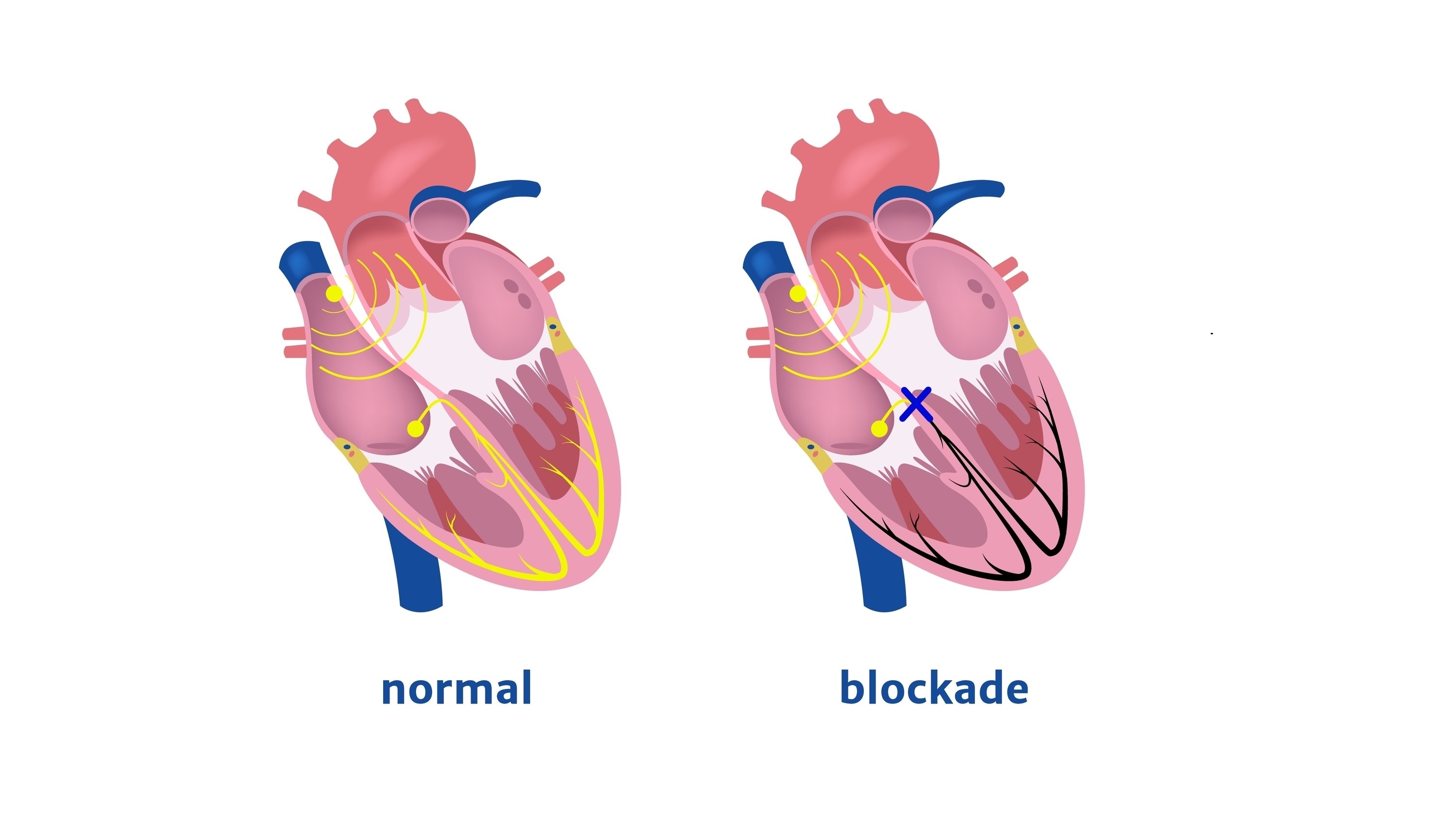 Block nhĩ thất độ 1 là gì? Có nguy hiểm không?