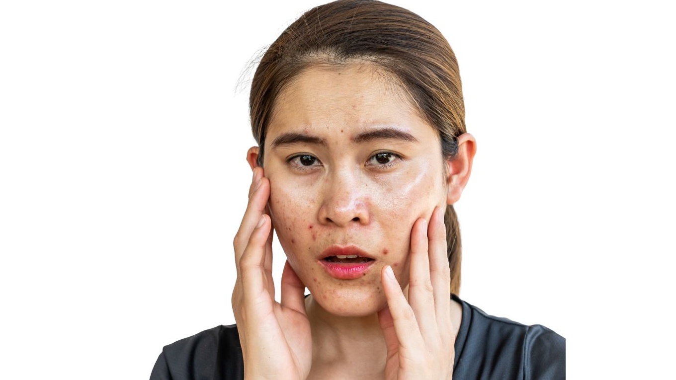 Gợi ý trọn bộ skincare cho da dầu mụn​