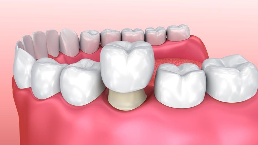 Giải đáp: Bọc răng sứ có bền không? Quy trình bọc răng sứ?