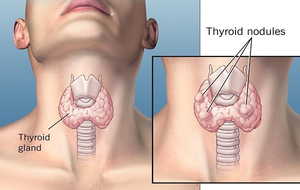 Bướu giáp nhân và những thông tin cần biết