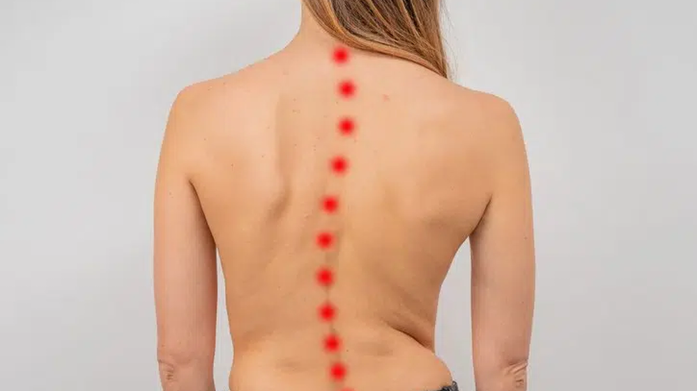Các bài tập phục hồi chức năng cho bệnh nhân vẹo cột sống